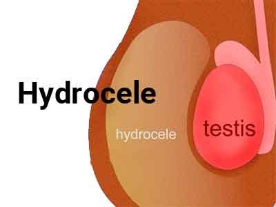 Hydrocele