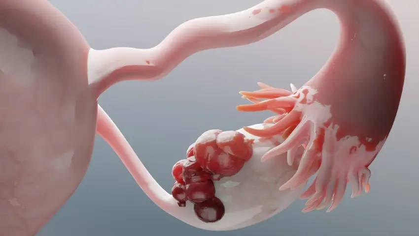 Ovarian-Cysts