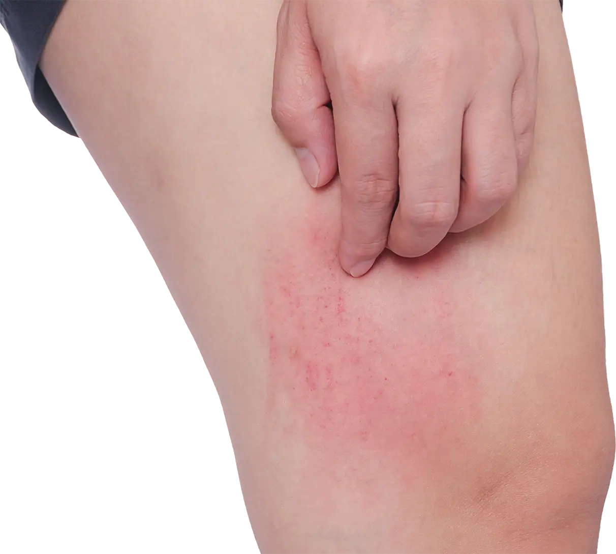 alergic