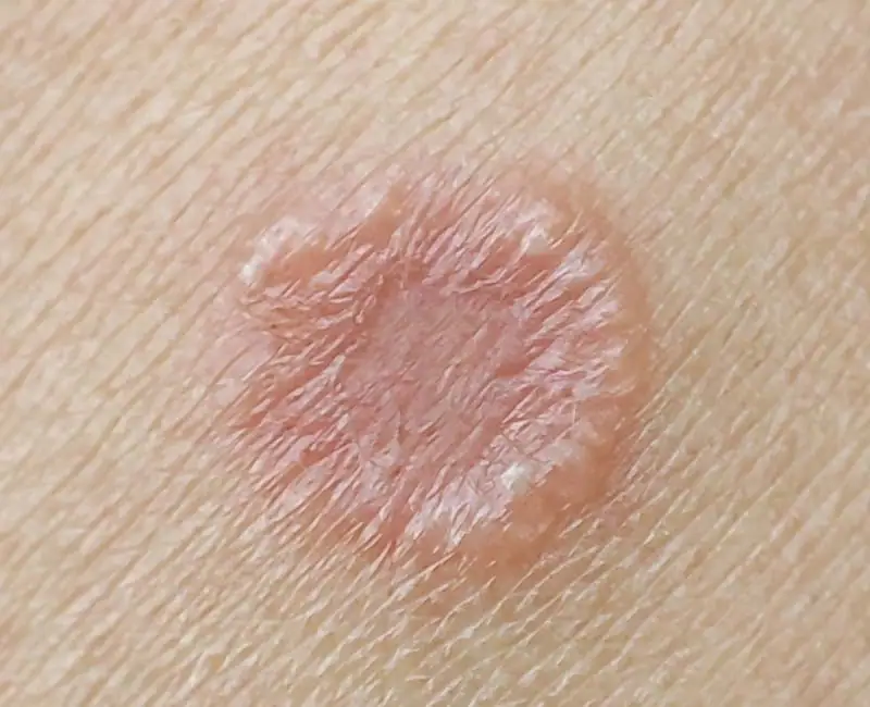 fungal skin