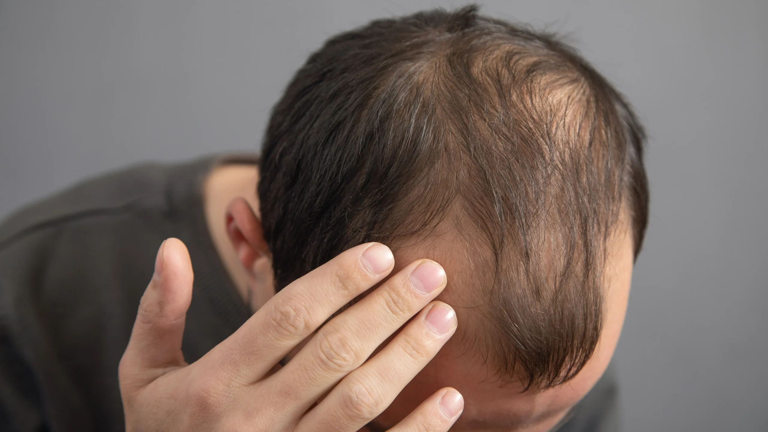 male_baldness_hair_loss_79c3025db3