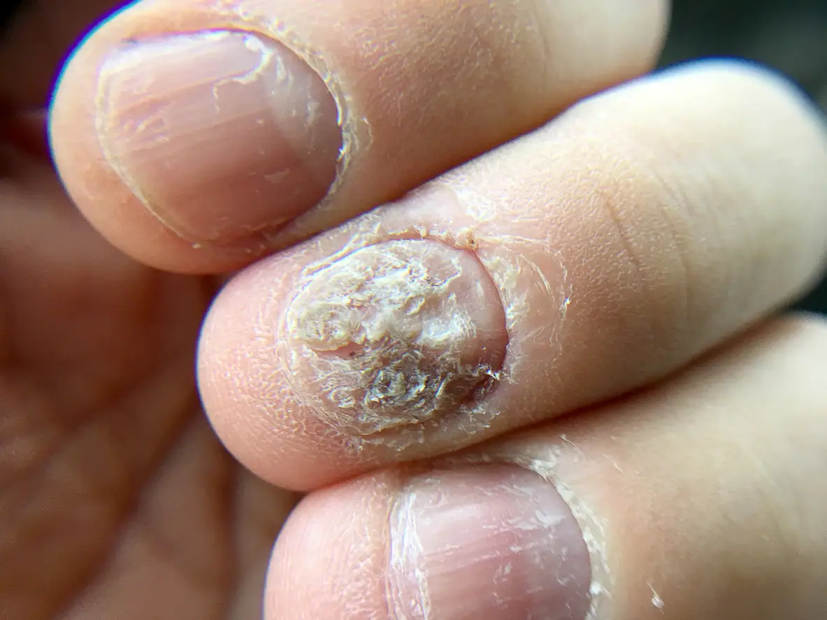 nail
