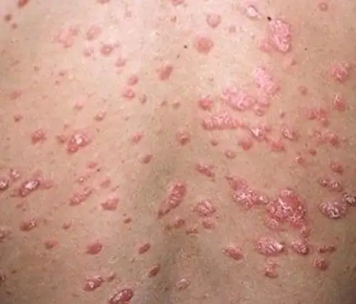 psoriasis