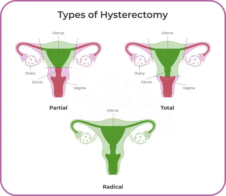 types-of-hysteroctomy