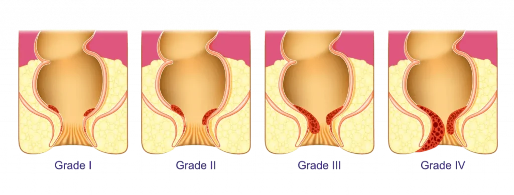 hemorrhoidsgrades-1024x389