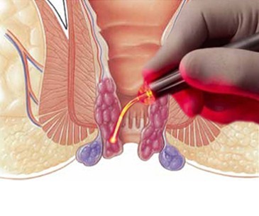 laser-piles-Treatment at Huma Hospital